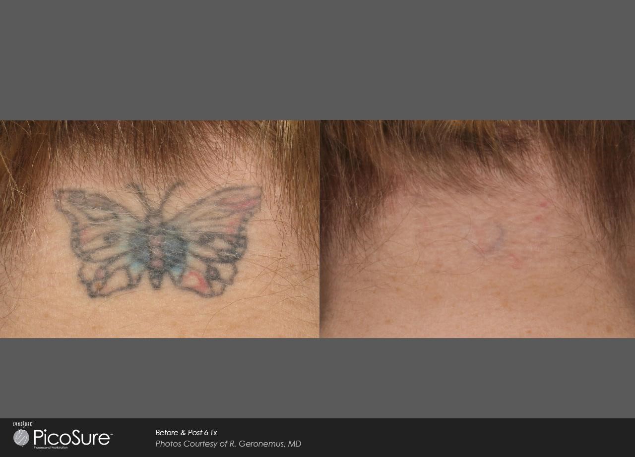 tummy tuck scars