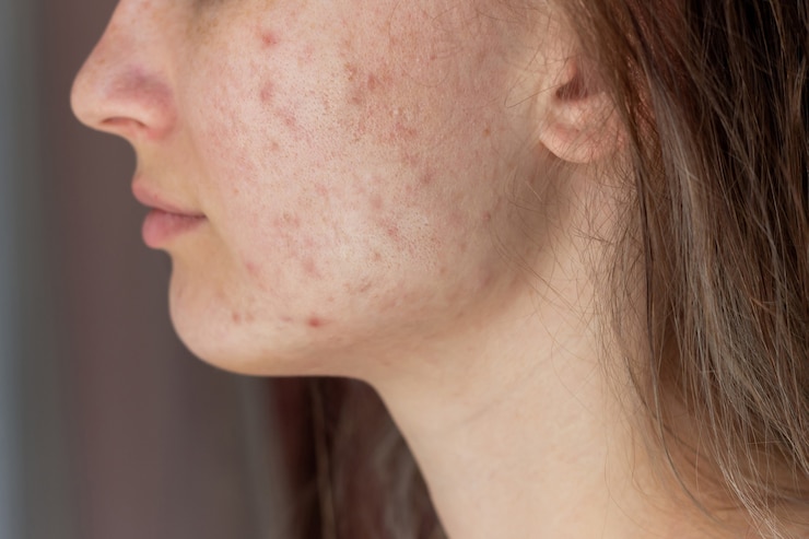 Acne Scar Treatment in Dubai