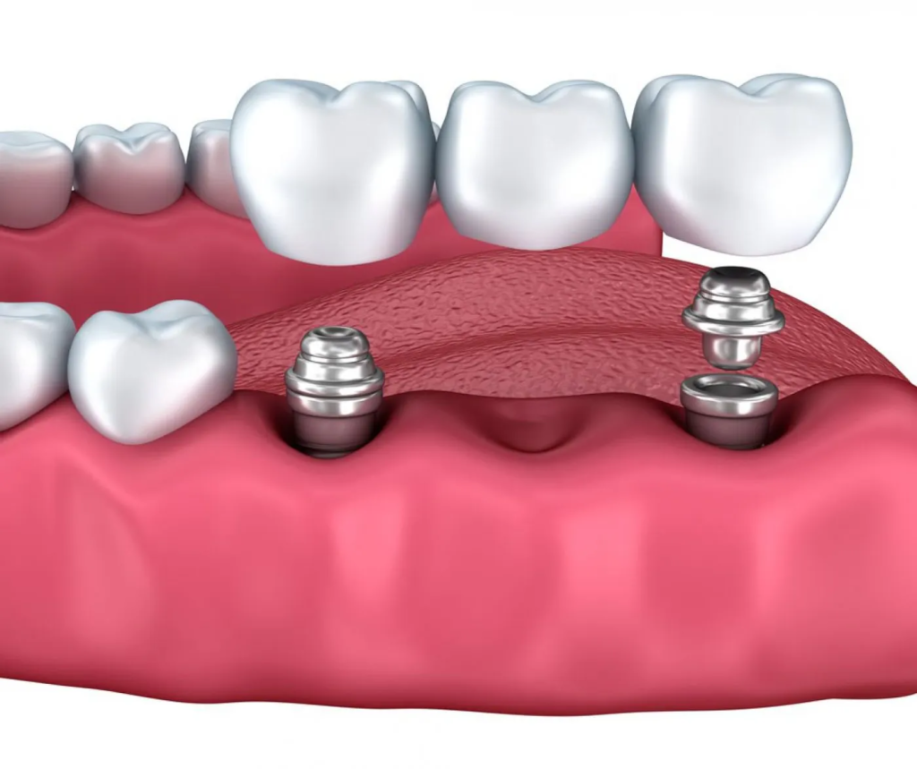 Dental Implants for Seniors Is It Too Late