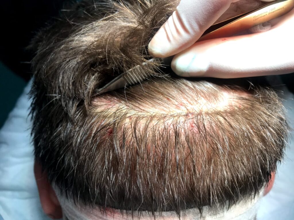 FUT vs. FUE Which Hair Transplant Option Is Right for You