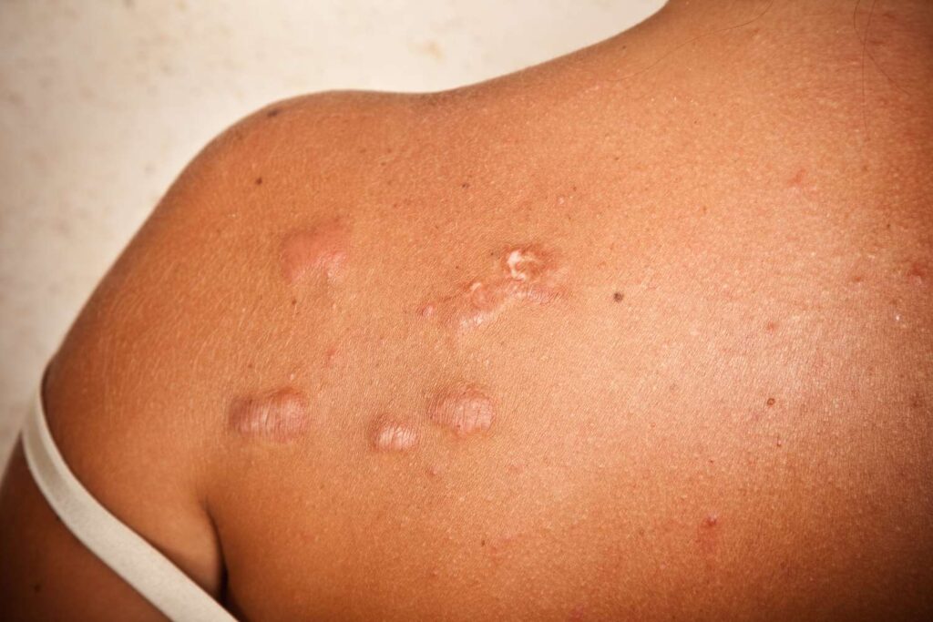 Keloid Treatment in Dubai