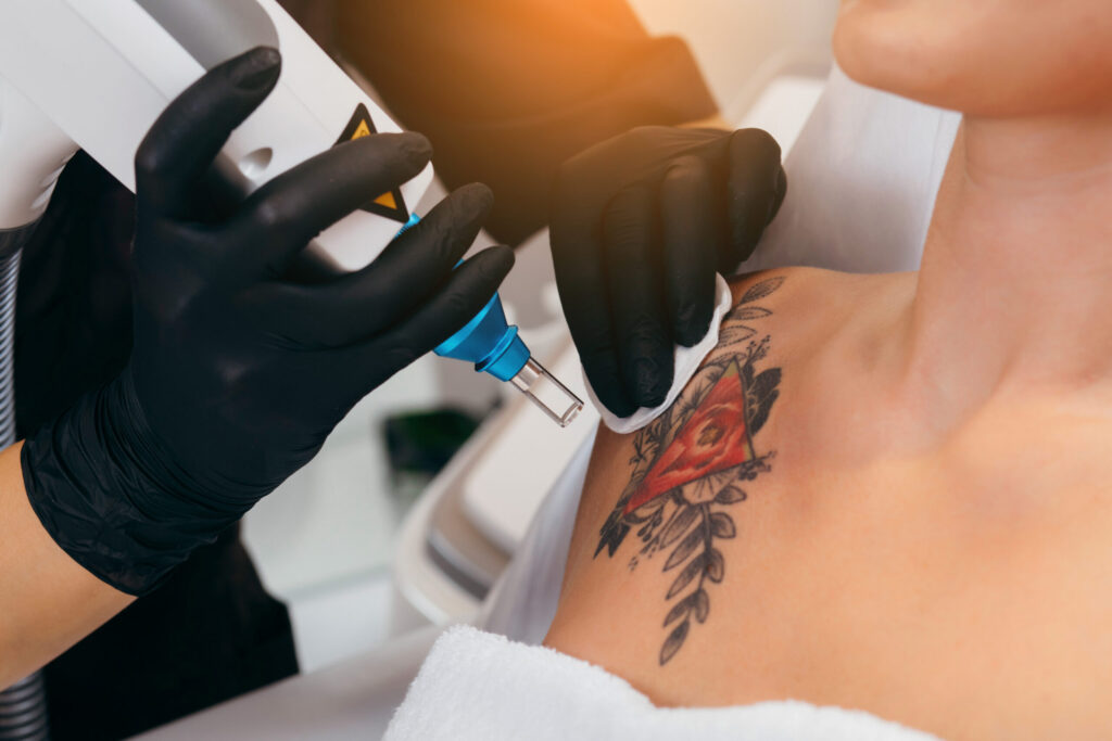Picosure Laser Tattoo Removal Dubai