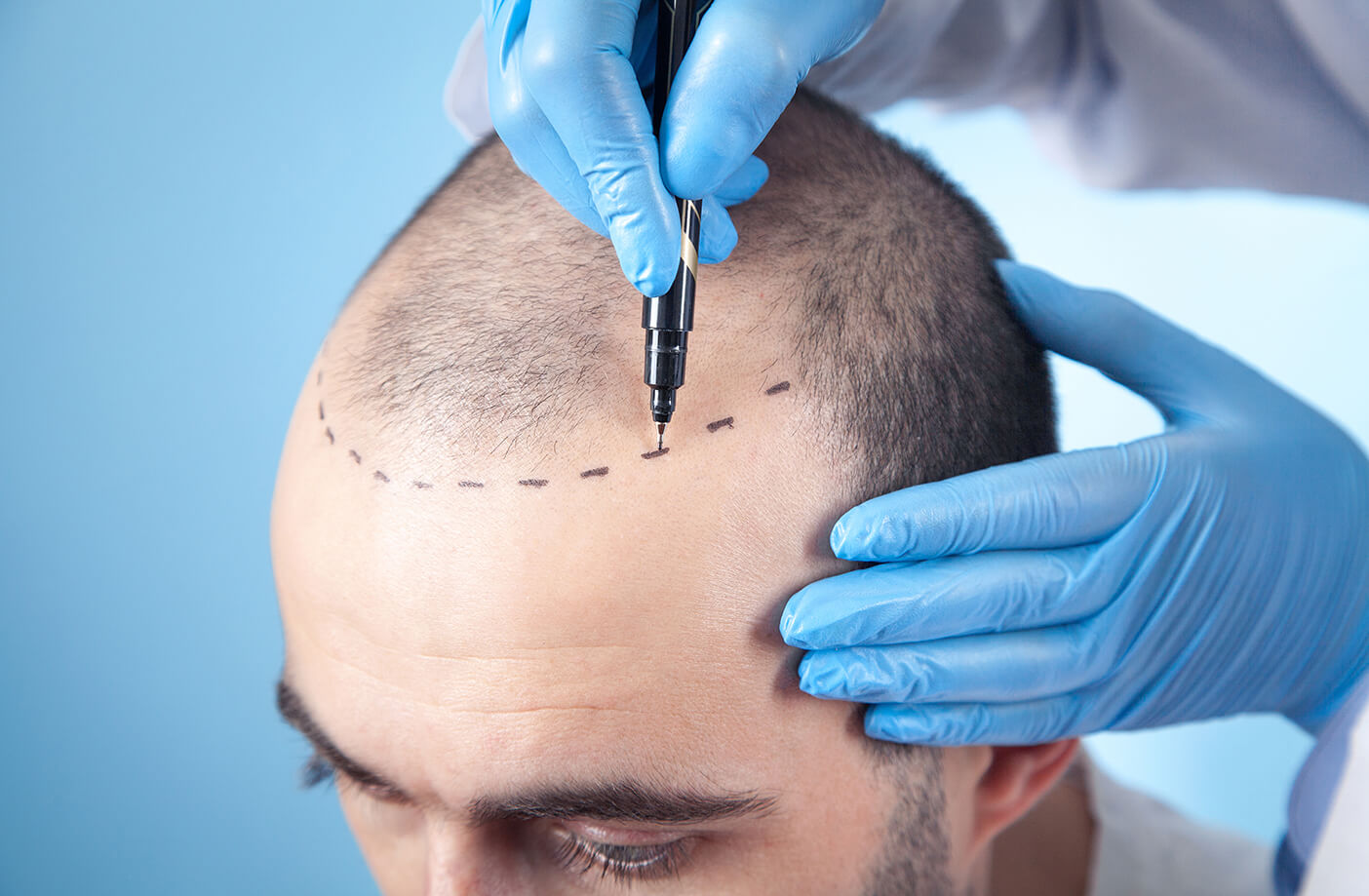 Say Goodbye To Hair Loss And Hello To New You