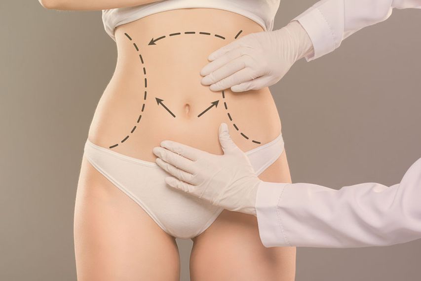 Recovery After Tummy Tuck