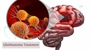 Glioblastoma Cancer in India: Role of Ayurveda and Alternative Therapies